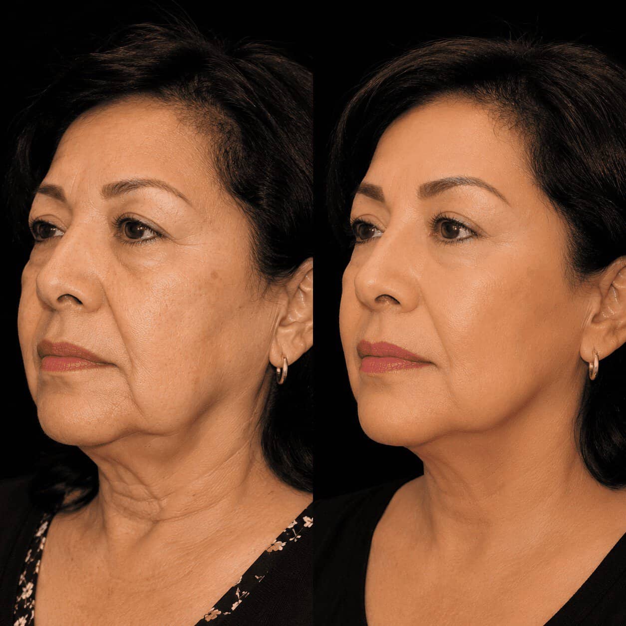 Risultato prima e dopo di un lifting cervico-facciale eseguito in Turchia con ringiovanimento naturale del viso e del collo.