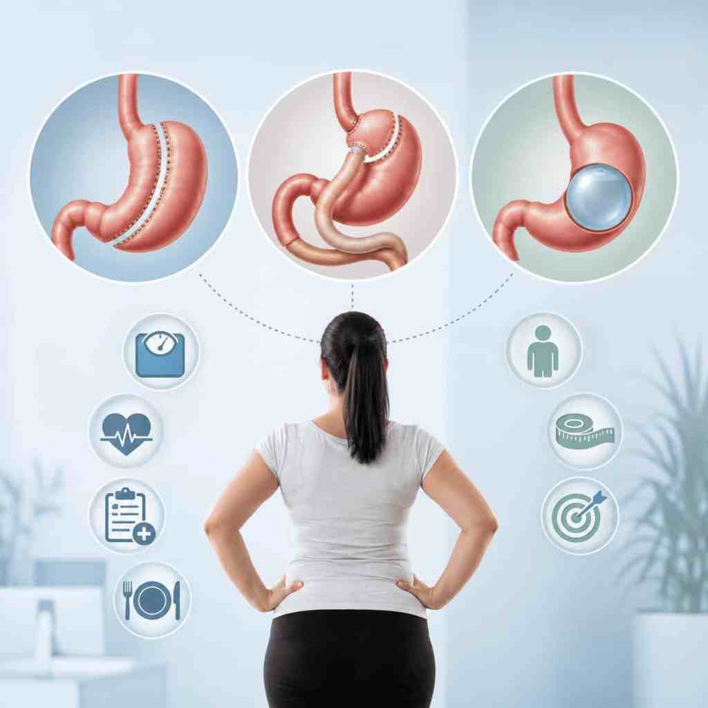 Illustrazione che confronta sleeve gastrectomy, bypass gastrico e palloncino gastrico per scegliere la tecnica di chirurgia bariatrica più adatta.