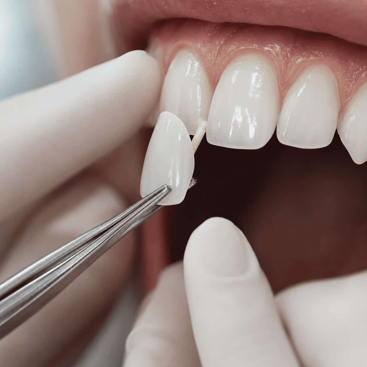 Posizionamento preciso di una faccetta dentale per ridurre il rischio di distacco.