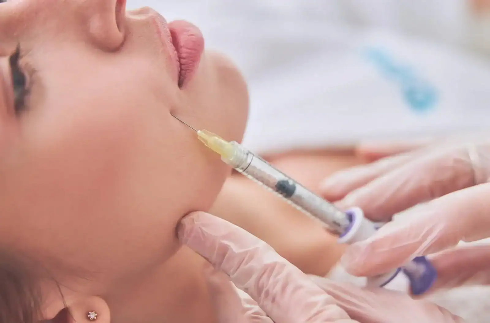 Combien de seringues d'acide hyaluronique faut-il pour le visage