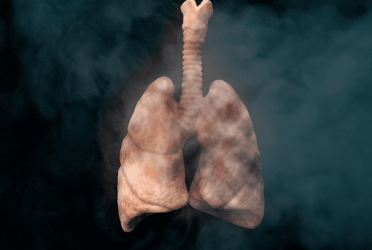 a lung cancer