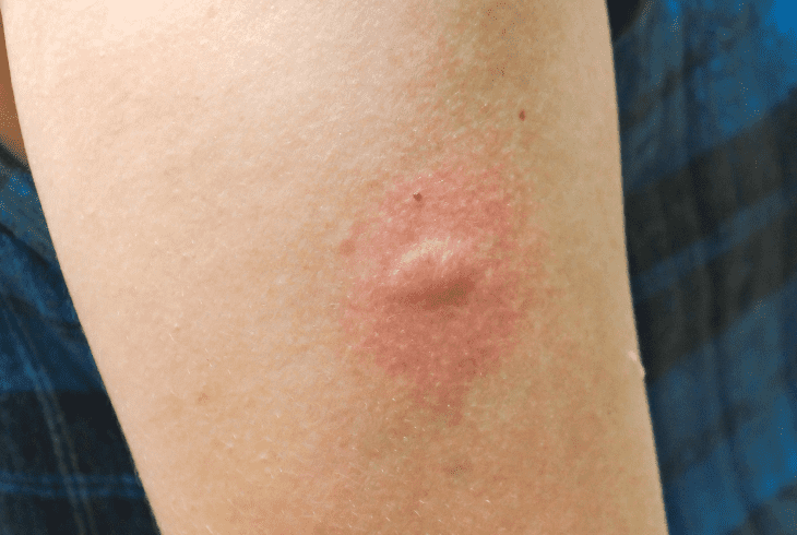 a flea bite