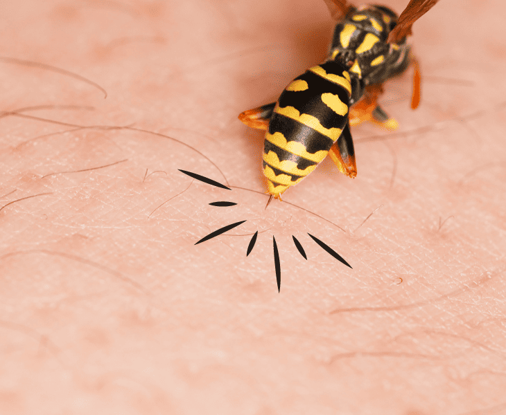 stung by a wasp