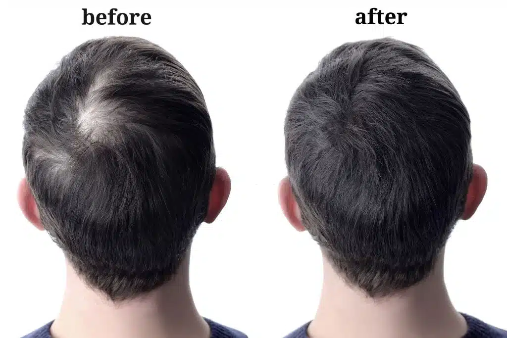 Know Latest Painless Hair Transplant Therapy & Cost.(2023) painless hair transplant