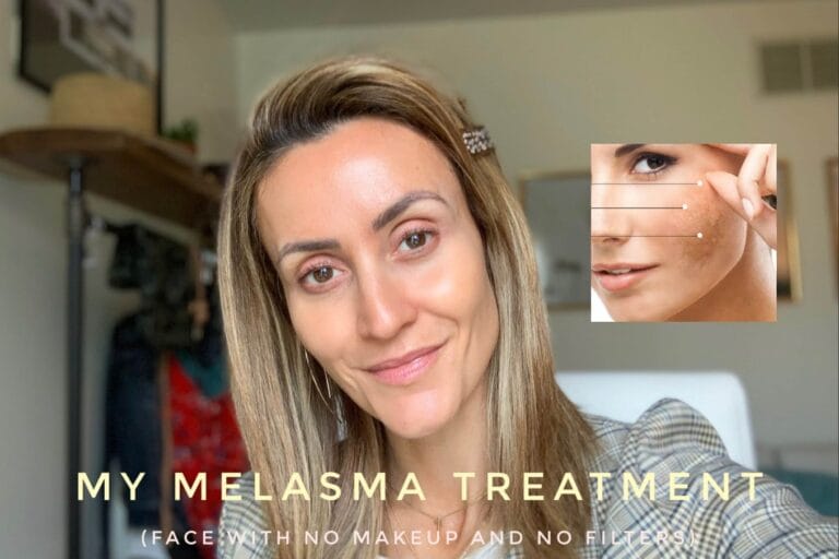 curar el melasma