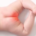 Érythème fessier du nourrisson : Causes et traitements efficaces