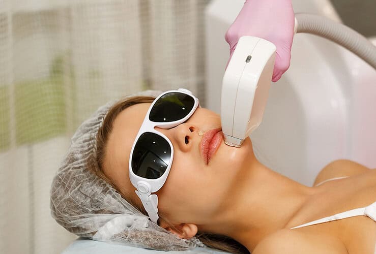 Épilation au laser du visage