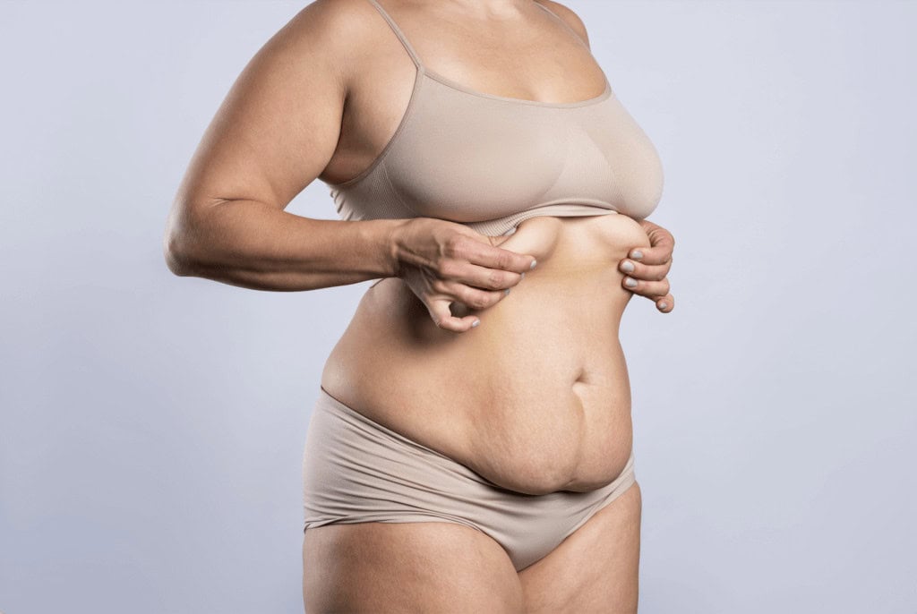prise en charge abdominoplastie après 3 grossesses