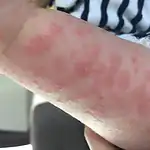 allergie lessive