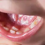 dent définitive qui pousse derrière dent de lait que faire