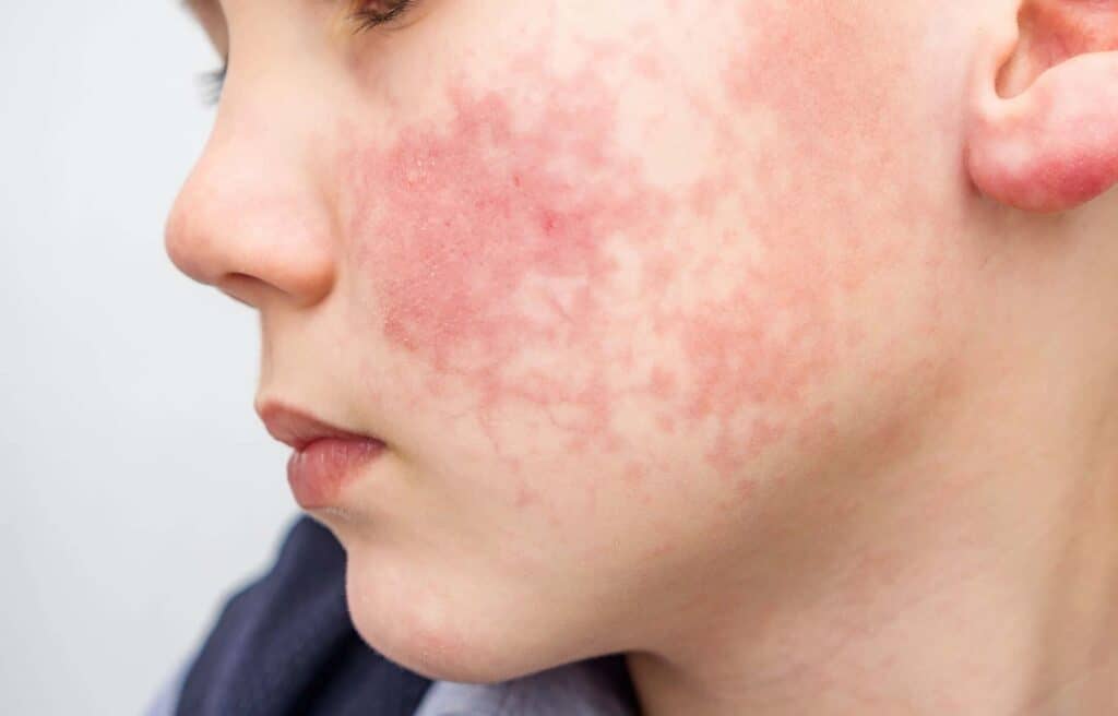 Ma rosacée a disparu : rémission réelle ou accalmie temporaire ? 2 Ma rosacée a disparu avis
