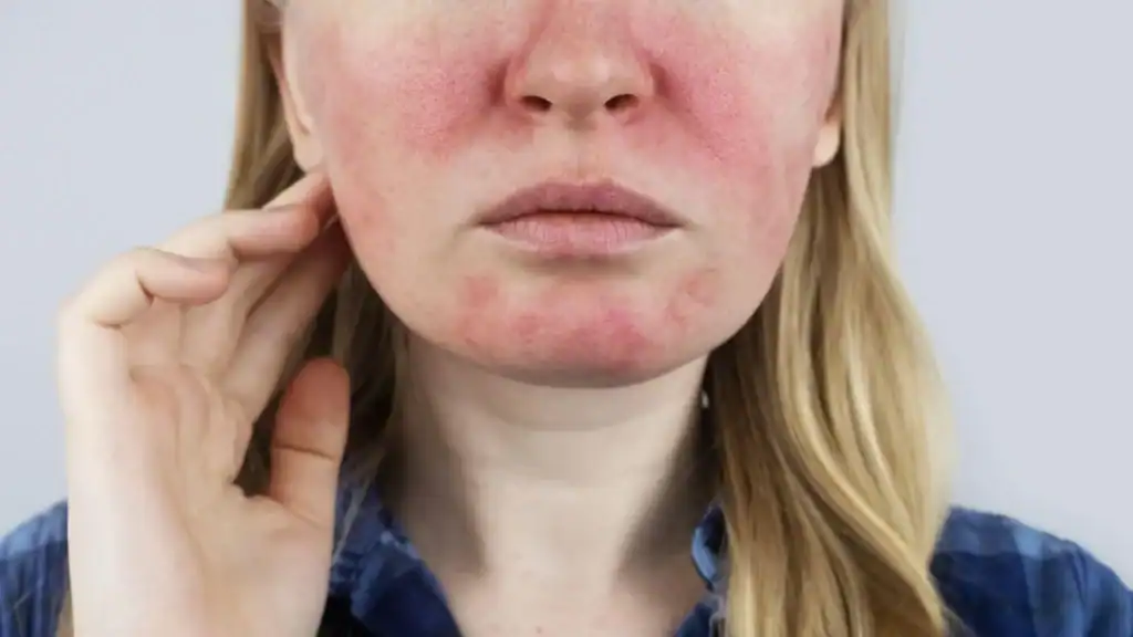 Ma rosacée a disparu : rémission réelle ou accalmie temporaire ? 4 Ma rosacée a disparu causes