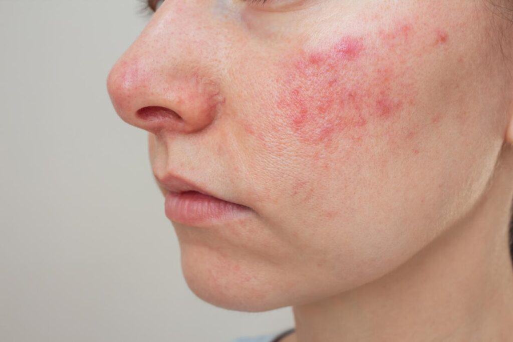Ma rosacée a disparu : rémission réelle ou accalmie temporaire ? 5 Ma rosacée a disparu solution