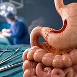 gastro entero anastomose
