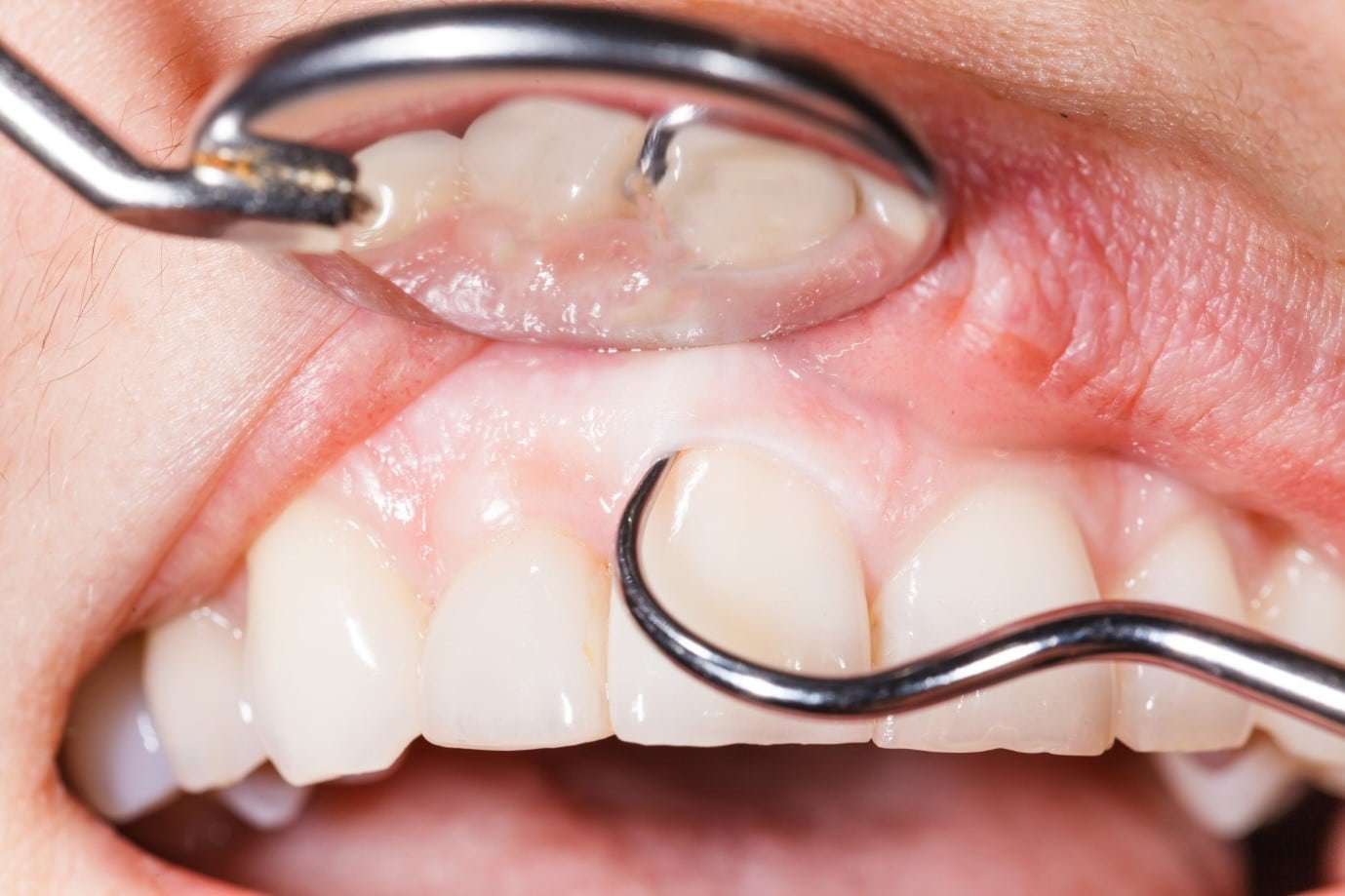 A Guide To Gum Recession Causes