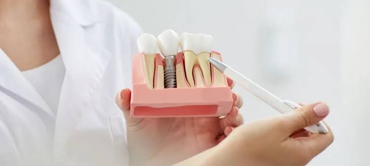 Dental Implant Surgery