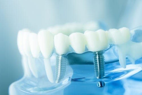 Enhancing Smiles: A Comprehensive Guide To Dental Implants In Brisbane And Cosmetic Dentistry In Sydney 1