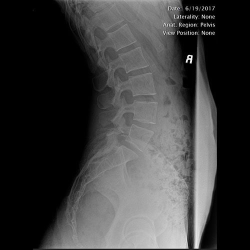 Normal lat lumbar
