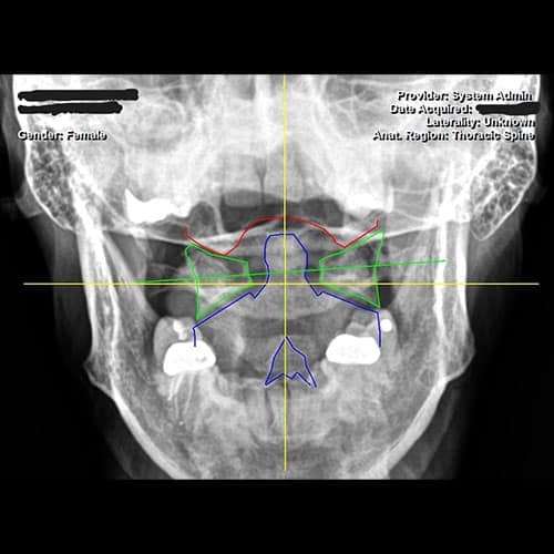 x-ray of atlas subluxation