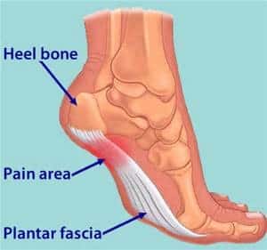 Illustration of foot with heel bone, pain area, and plantar fascia