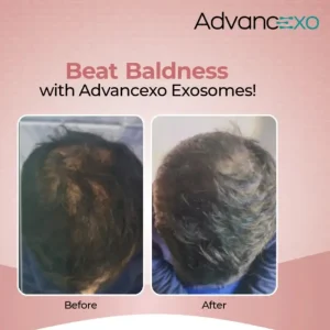Beat Baldness
