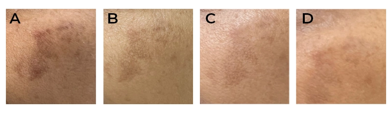 Benefits of Exosomes with Microneedling