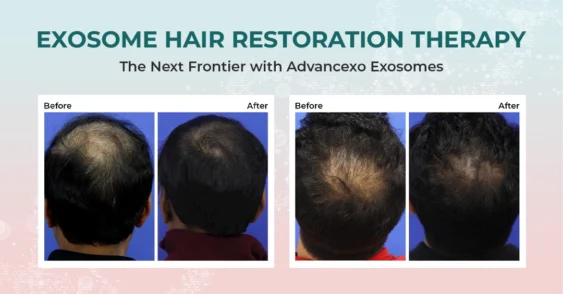 Exosome Therapy for Hair Loss: The Cutting-Edge Solution with Advancexo Exosomes