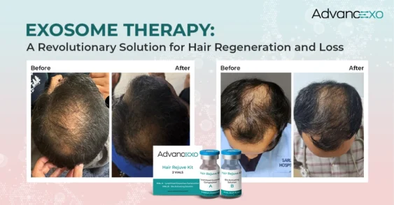 Exosome Therapy: A Revolutionary Solution for Hair Regeneration and Loss