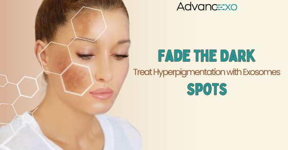 Fade the Dark Spots: Treat Hyperpigmentation with Exosomes