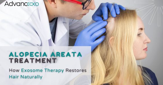 Exosome Therapy for Alopecia Areata for Hair Rejuvenation