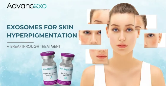 Exosomes for Skin Hyperpigmentation: A Breakthrough Treatment