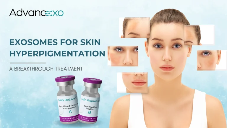 Read more about the article Exosomes for Skin Hyperpigmentation: A Breakthrough Treatment