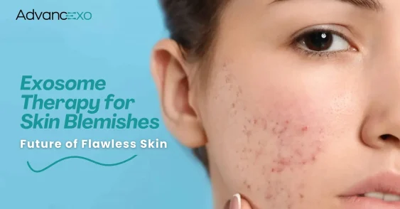 Exosome Therapy for Skin Blemishes: Future of Flawless Skin