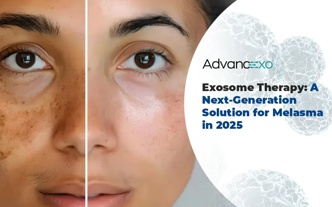 You are currently viewing Exosome Therapy: A Next-Generation Solution for Melasma in 2025