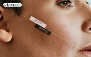 Microneedling-and-Exosomes