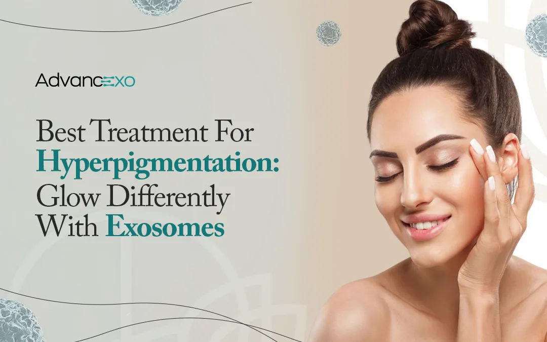 You are currently viewing Best Treatment For Hyperpigmentation: Glow Differently With Exosomes