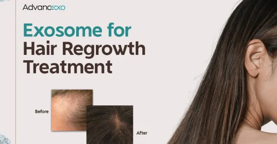 Exosome for Hair Regrowth Treatment: What Science Tell Us, What to Expect