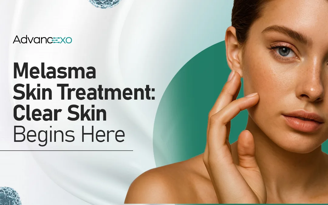 You are currently viewing Melasma Skin Treatment​- Clear Skin Begins Here