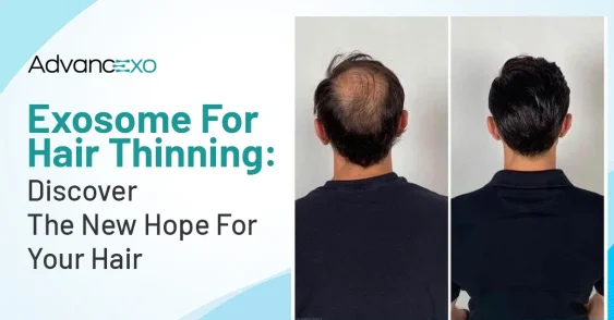Exosome for Hair Thinning: Discover the New Hope for Your Hair