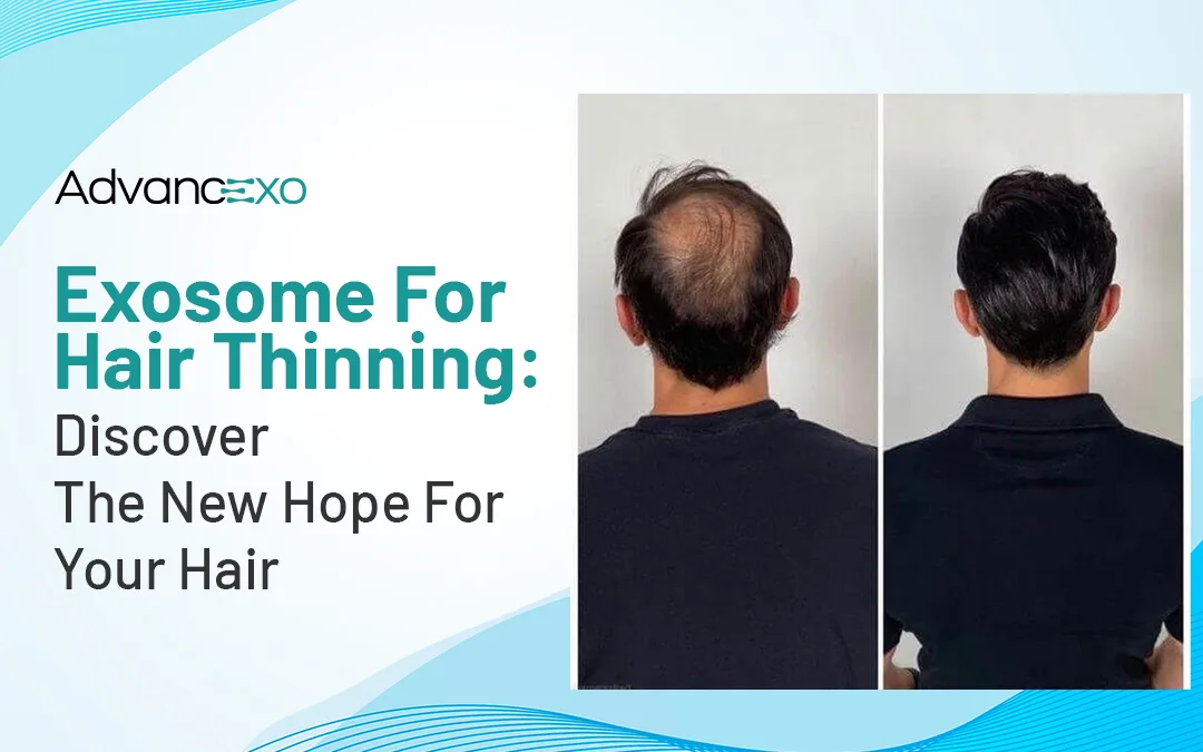 You are currently viewing Exosome for Hair Thinning: Discover the New Hope for Your Hair