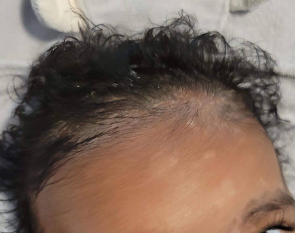 A close up of cradle cap on around the forehead area causing white patches