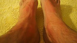 come curare la orticaria