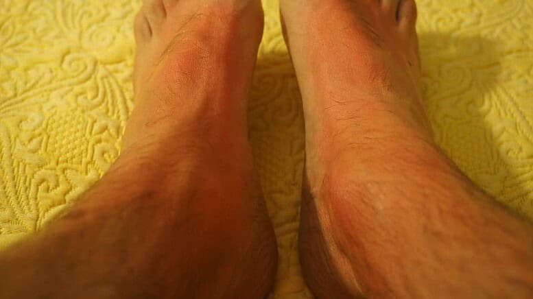 come curare la orticaria