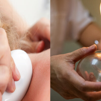 Cupping and Gua Sha