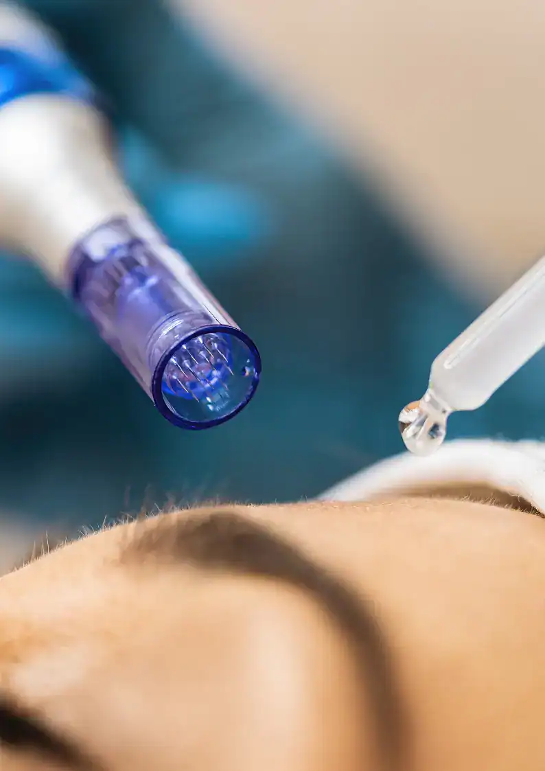 alt="Microneedling treatment in Vancouver at Belle Âme Skin and Beauty Lounge for skin rejuvenation"