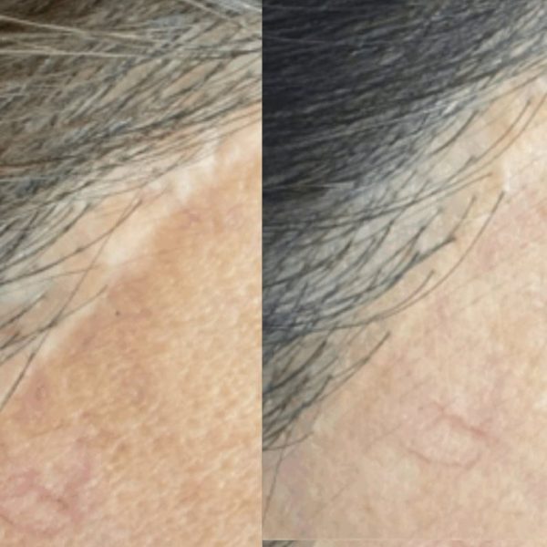 scar camouflage tattoo Vancouver