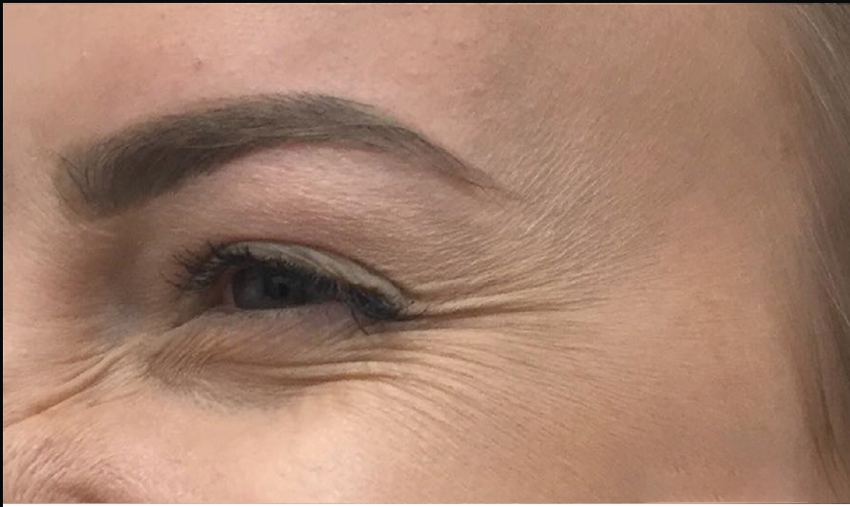 Before treatment