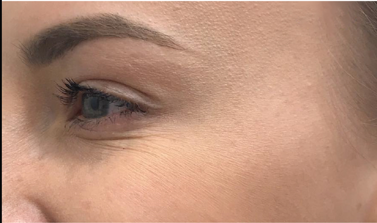 After treatment