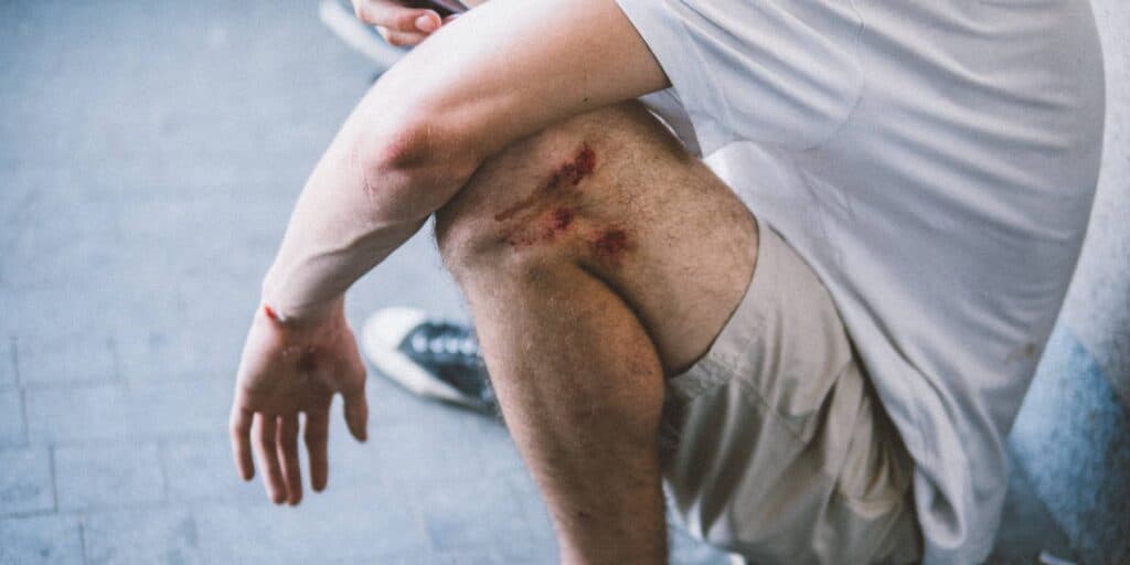 Man with leg injury from slip and fall accident in Mesa, Arizona.