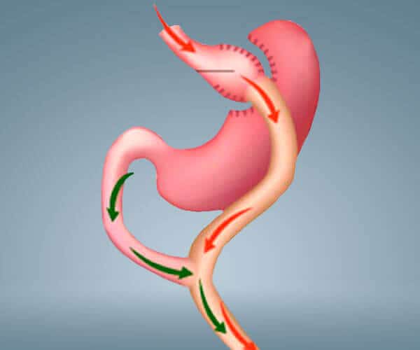 Img-BYPASS-GASTRICO1